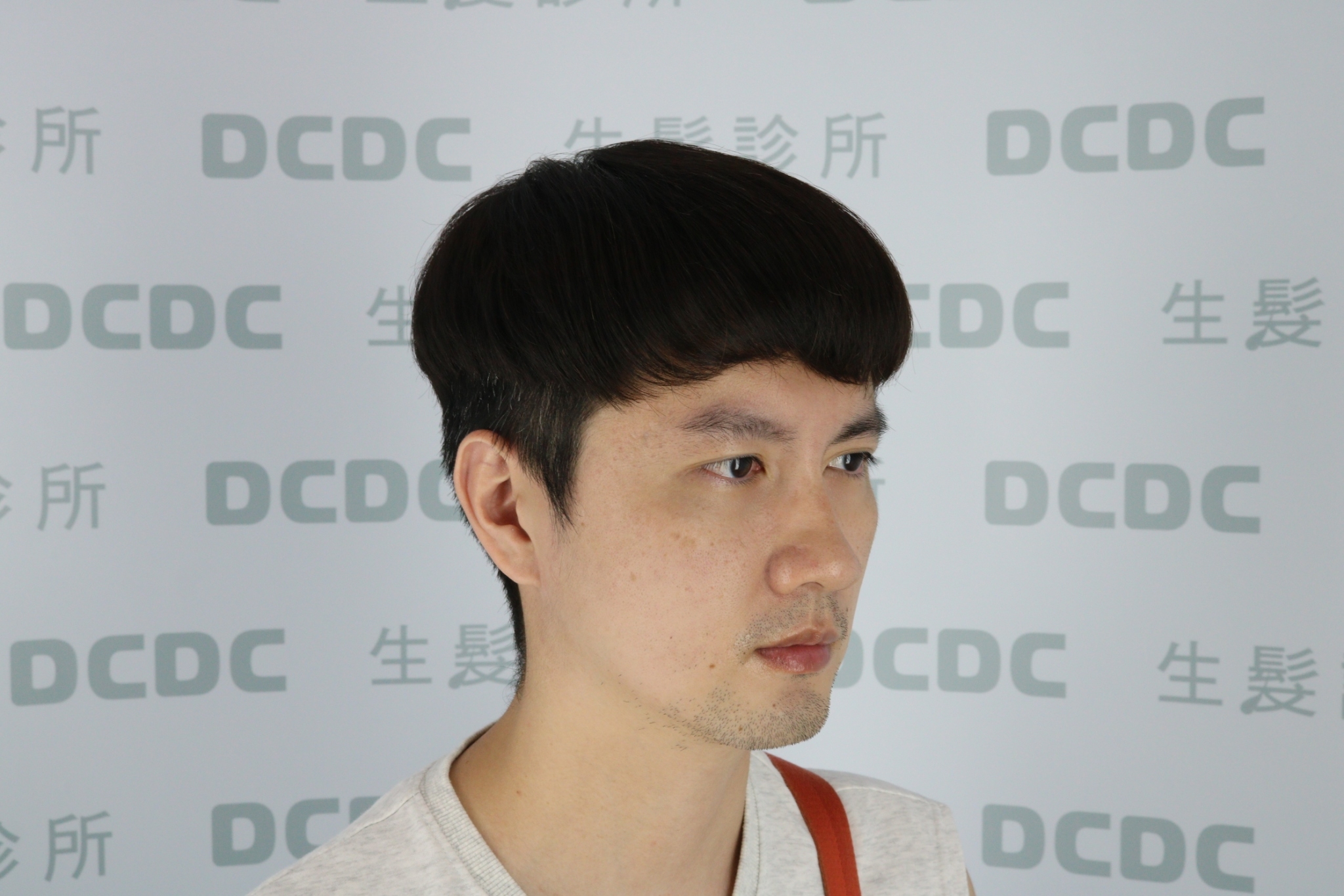 DCDC生髮診所-前額植髮加密飽滿側角毛流自然銜接成果